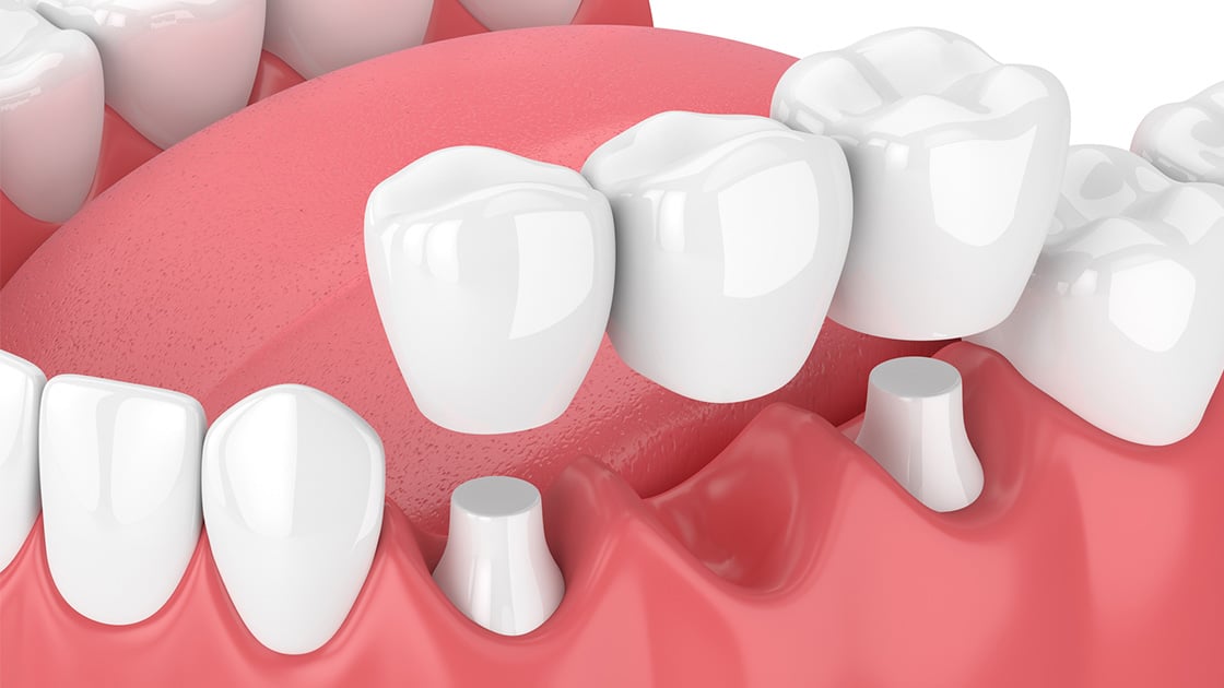 Dental bridge restoration