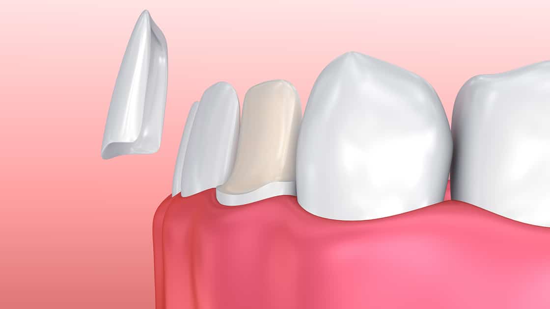 Dental veneers for a beautiful smile