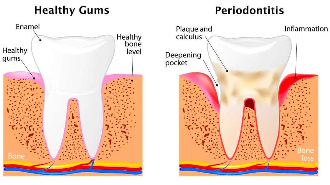 Periodontal disease treatment